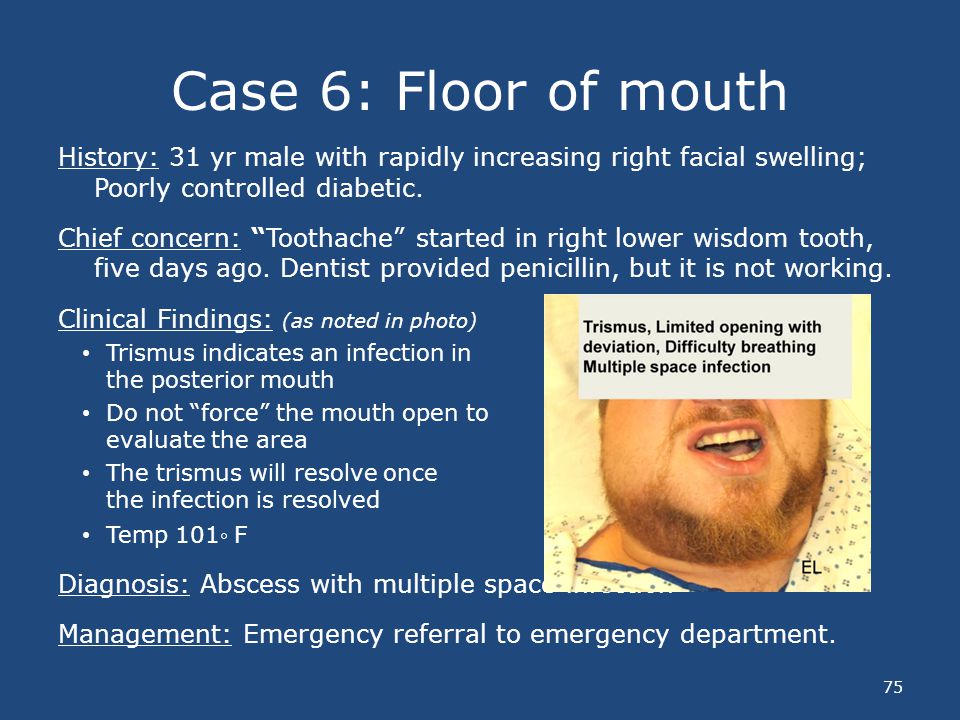 Case 1: Treatment for a Tooth Abscess